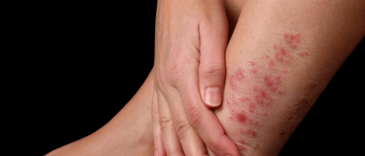 Psoriasis-Plaques auf der Haut des Beines