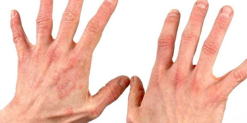 Psoriasis an den Händen, wie man Volksheilmittel behandelt