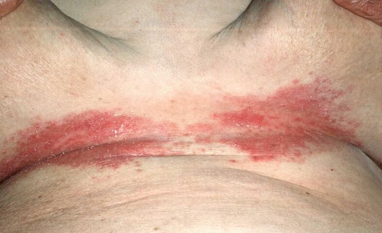 Psoriasis-Plaques unter der Brust