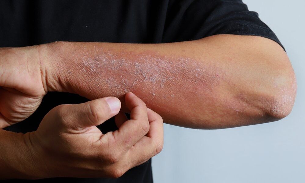 Psoriasis-Symptome am Arm