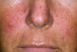 Symptome der Schuppenflechte im Gesicht